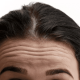 Forehead (1)